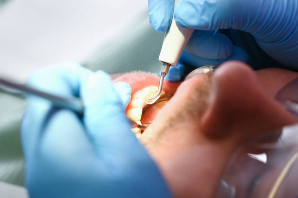 Best Emergency Treatment for Dental Infections or Abscesses in Wapakoneta, OH