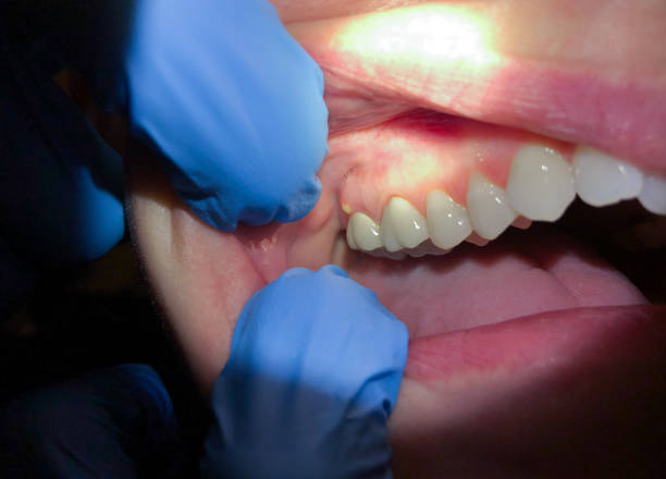 Best Emergency Root Canal Treatment in Wapakoneta, OH