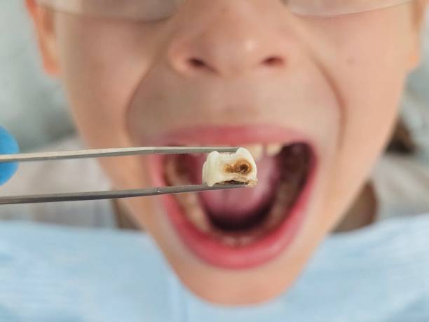 Best Emergency Dental Care for Broken or Chipped Teeth in Wapakoneta, OH